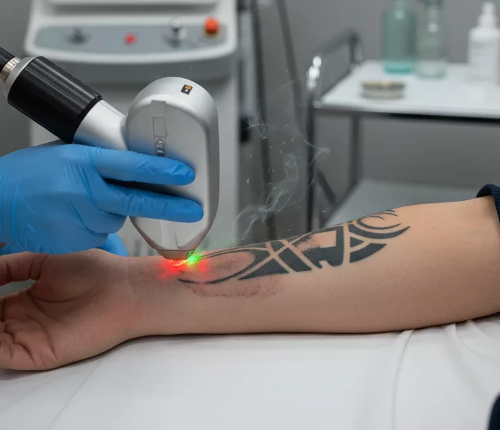 eliminacion tatuaje lanzarote